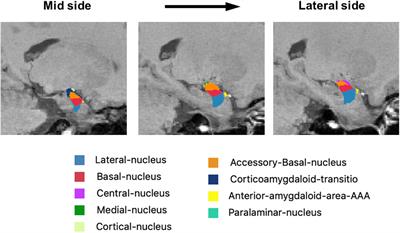Volume of Amygdala Subregions and Clinical Manifestations in Patients With First-Episode, Drug-Naïve Major Depression